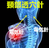 頸椎捻挫