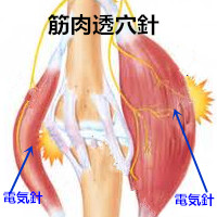 肉離れ