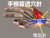 手根管症候群